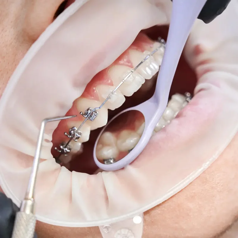 Patient with braces at ARC Dental Surgery in Blackpool
