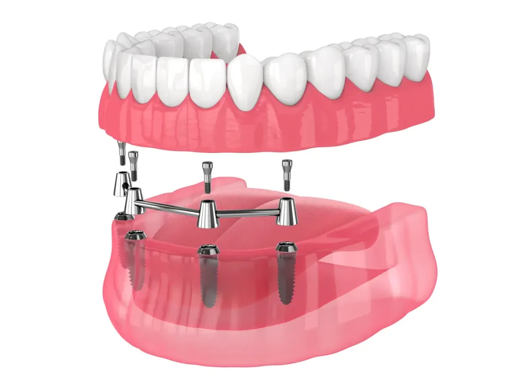 Implant retained dentures