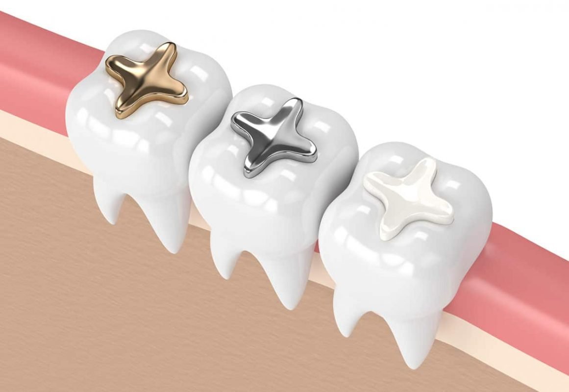 Dental filling treatment at ARC Dental Surgery in Blackpool
